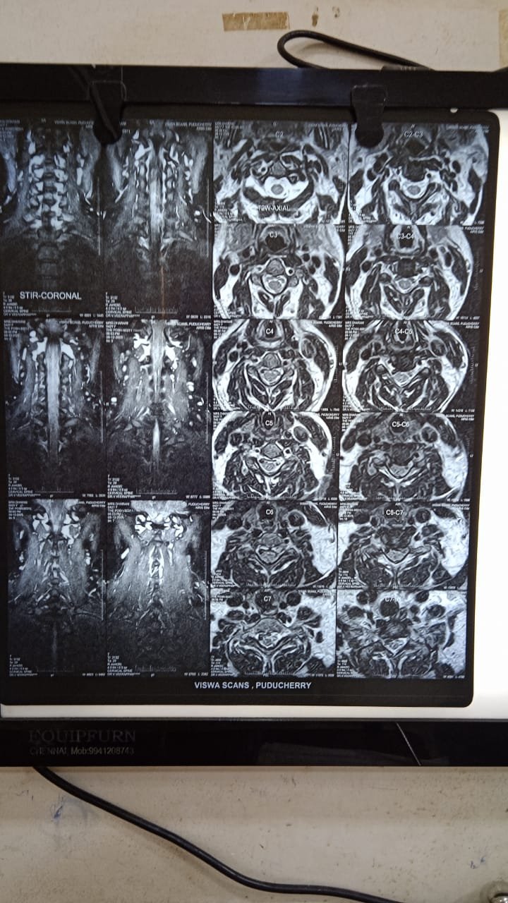 Surgical fixation